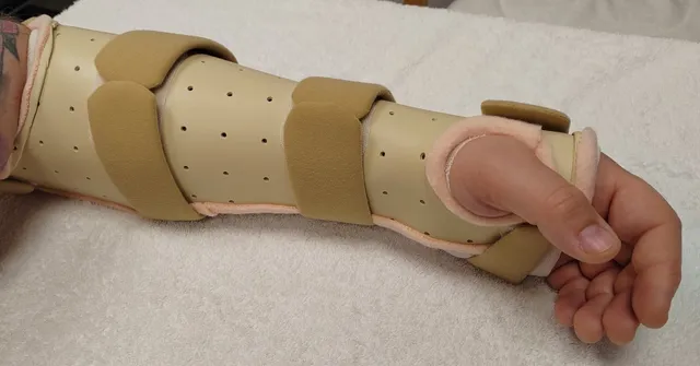 Custom hand splint made by Ms Michelle Razo, Consultant Hand Therapist Belfast