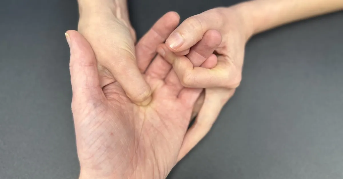 Close-up of a hand demonstrating trigger finger, treated by Ms Michelle Razo, Consultant Hand Therapist Belfast